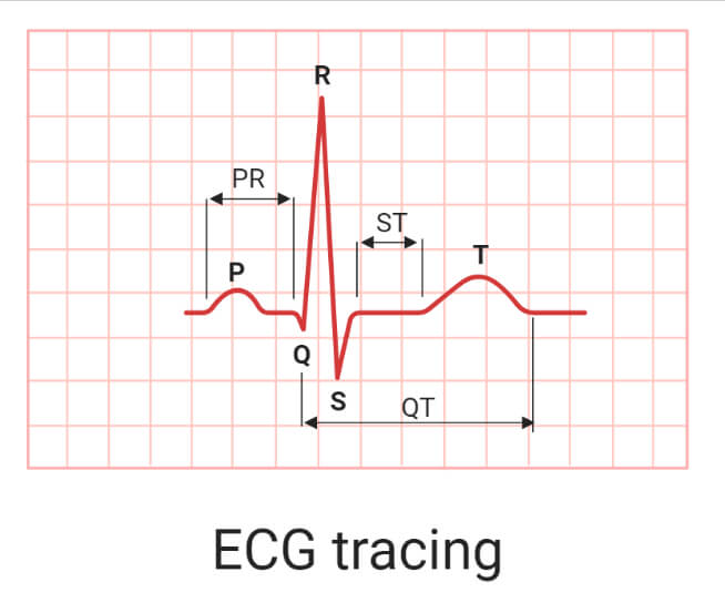 ECG tracing