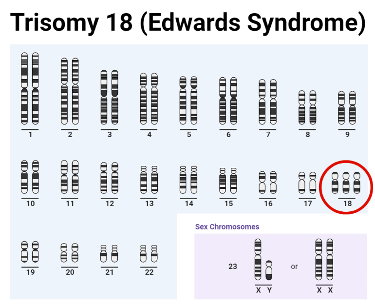 Trisomy 18 (Edwards syndrome)
