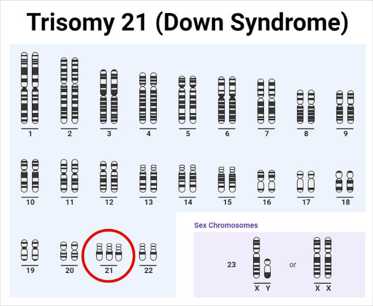 Trisomy 21 (Down syndrome)