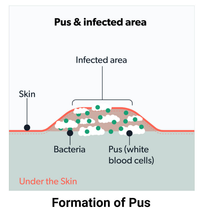 Formation of Pus