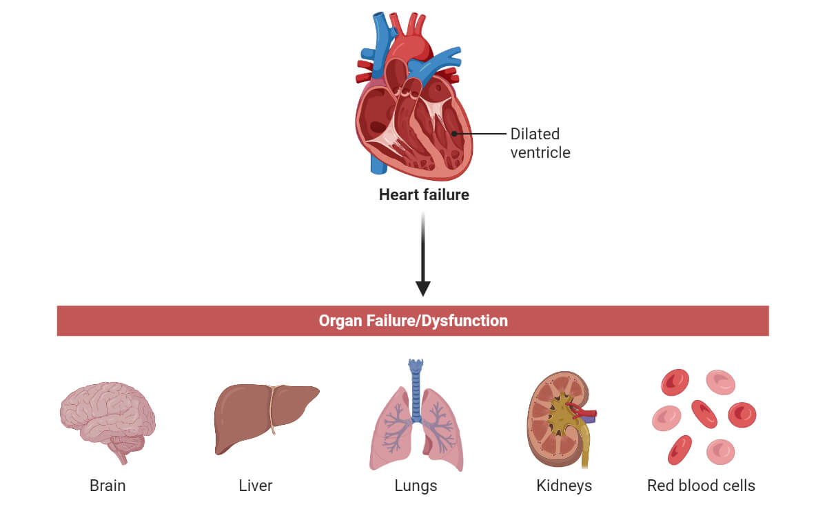 Heart Failure and Organ Failure