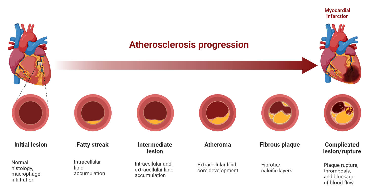 Atherosclerosis Progression