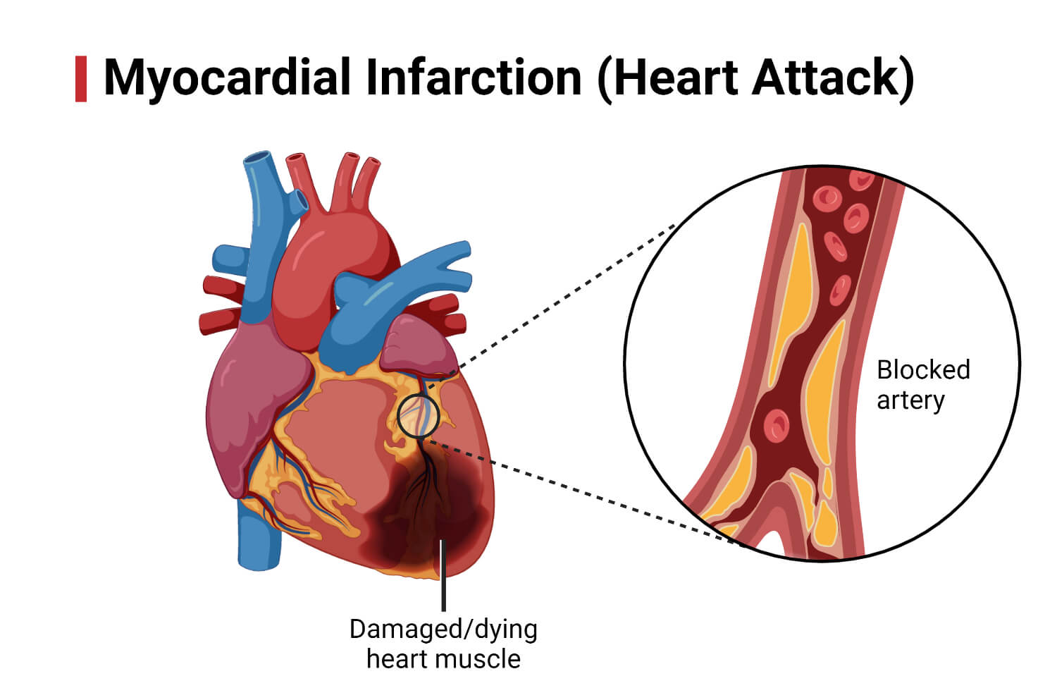 Myocardial Infarction (Heart Attack)